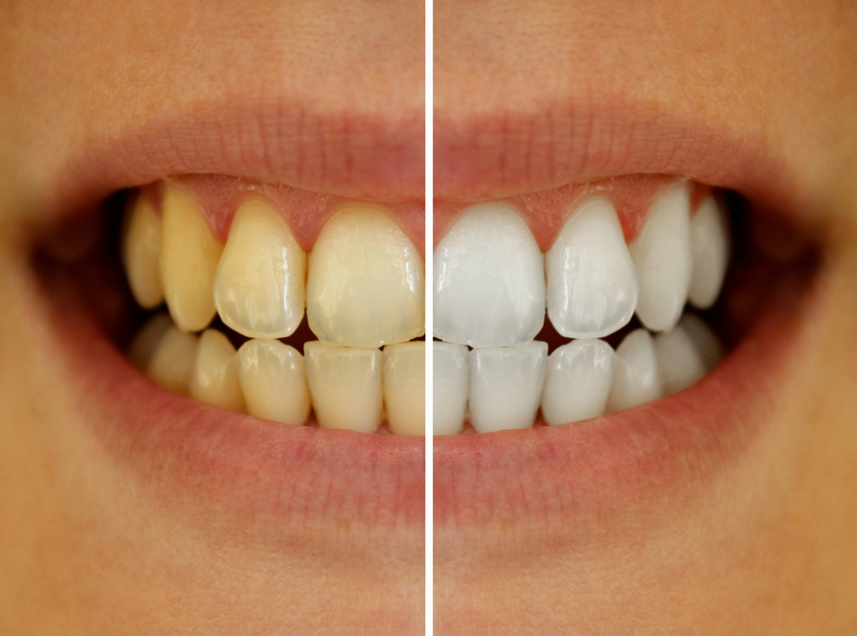 Teeth whitening results